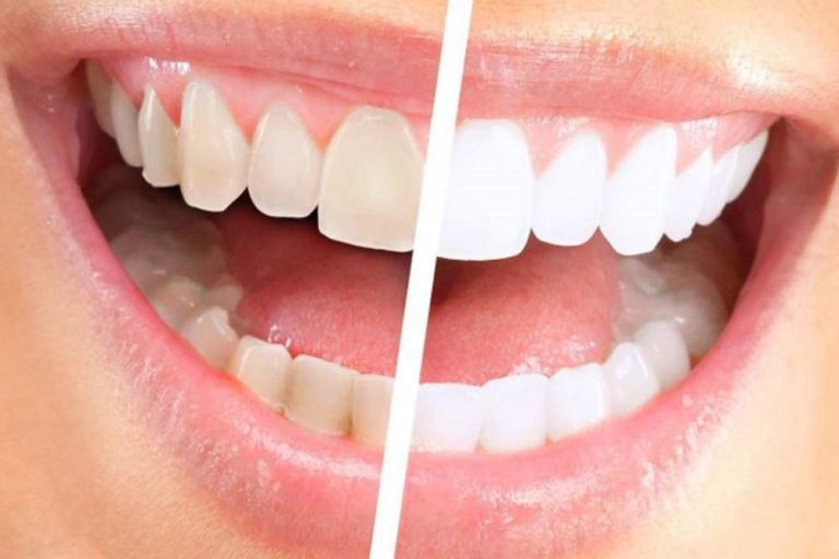 sorriso prima e dopo sbiancamento dentale