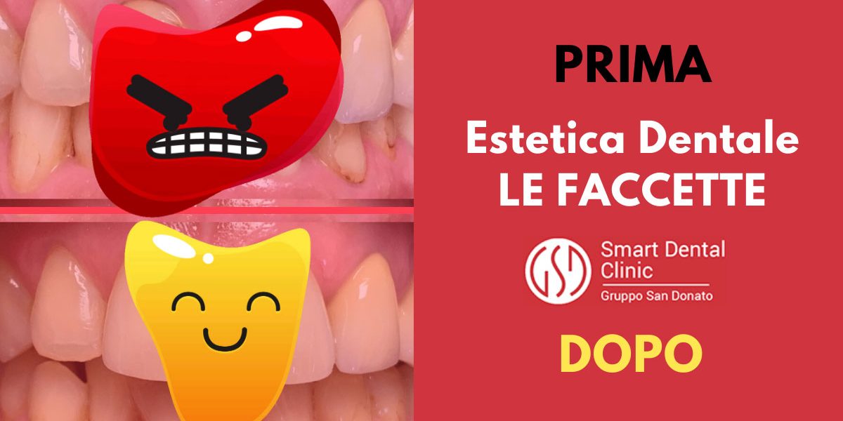 dentatura prima e dopo l'applicazione delle faccette dentali