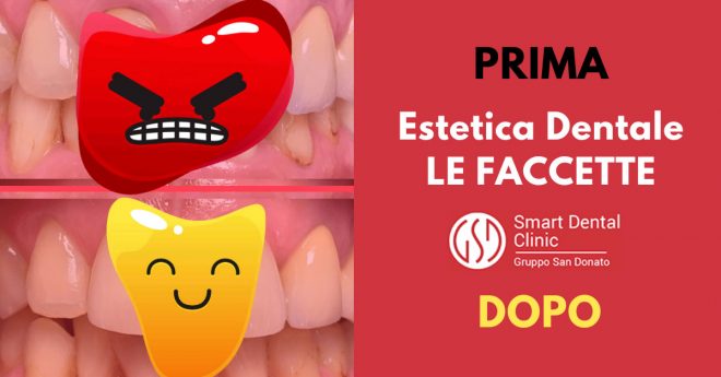 dentatura prima e dopo l'applicazione delle faccette dentali