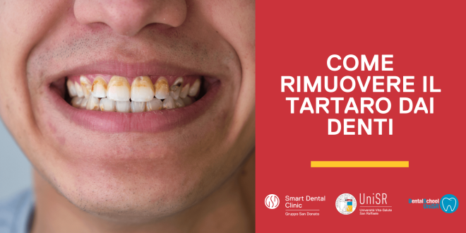 come rimuovere il tartaro dai denti? denti macchiati a causa del tartaro