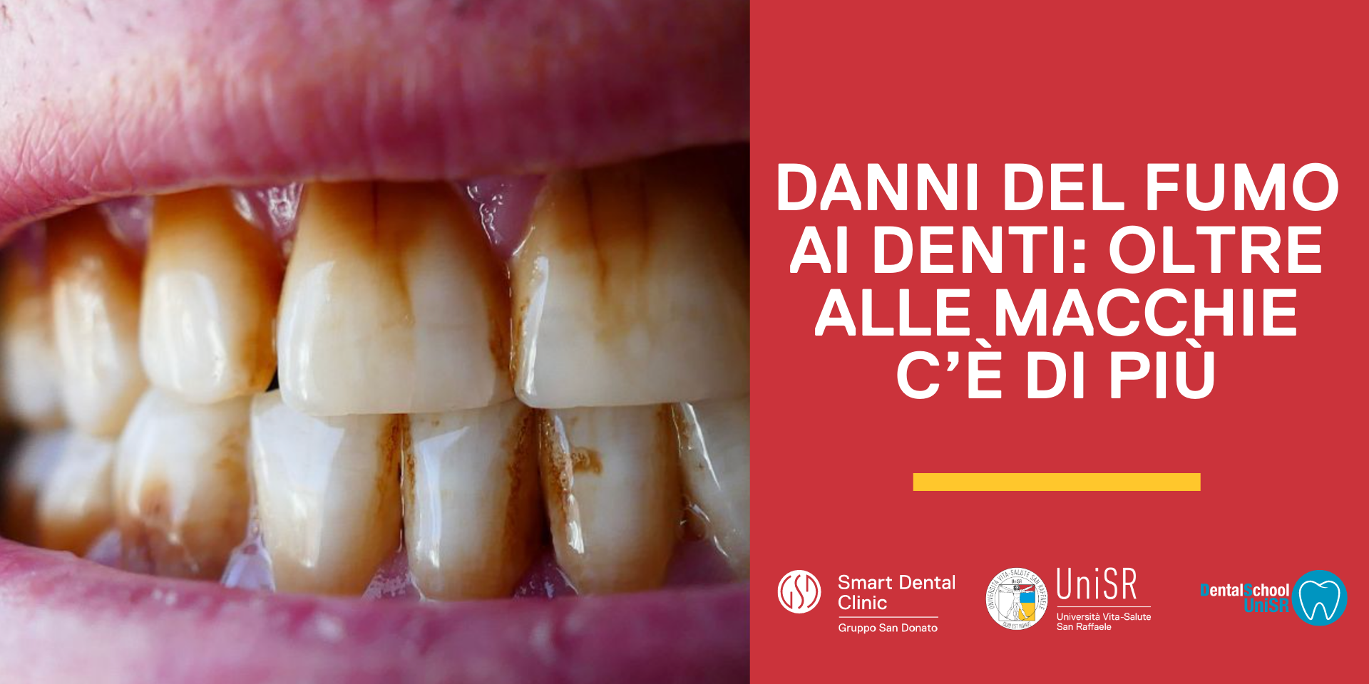 Denti macchiati a causa del fumo